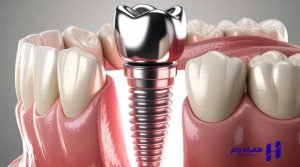 قیمت ایمپلنت اقساطی تهران