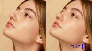 انواع جراحی زیبایی بینی
