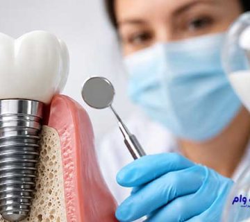 بهترین دندانپزشک ایمپلنت تبریز